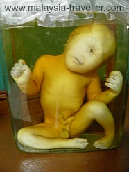 Preserved Human Foetus