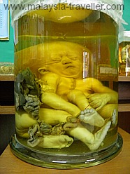 Preserved Foetus Twins